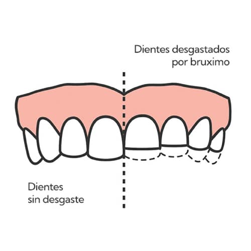 bruxismo-1-clinica-amaranta2
