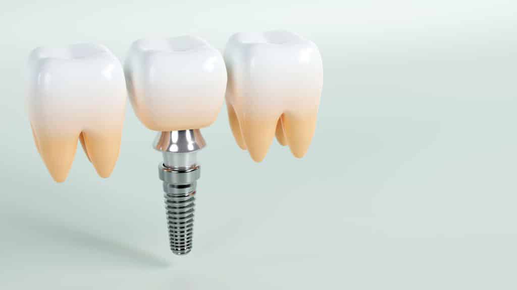 Implantes dentales santa cruz de tenerife